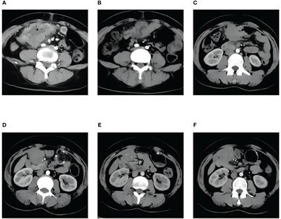 Case Report: A management strategy and clinical analysis of primary squamous cell carcinoma of the colon